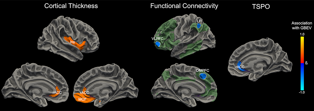 Blast Exposure Associations with Neuroimaging Biomarkers. Cumulative blast exposure was associated with changes in cortical thickness (left), functional connectivity (middle) and neuroimmune markers (right).